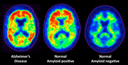 PET scans can help forecast the onset of dementia years in advance